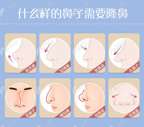 需要隆鼻的鼻子类型