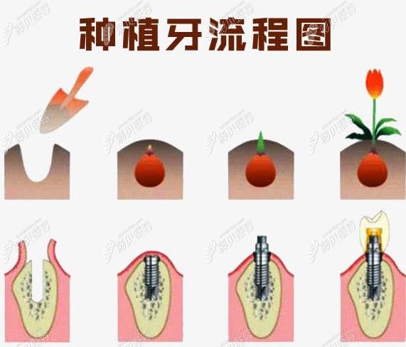 法国安卓健种植牙过程图解