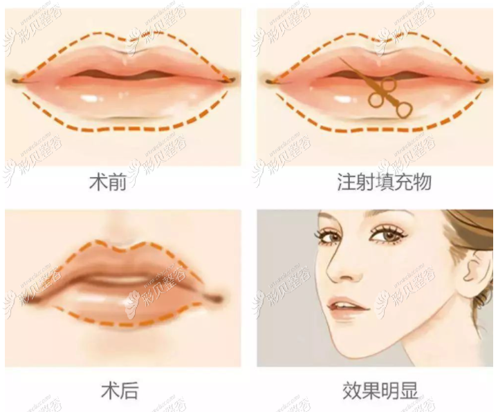 玻尿酸或自体脂肪丰唇过程图解 玻尿酸或自体脂肪丰唇过程图解