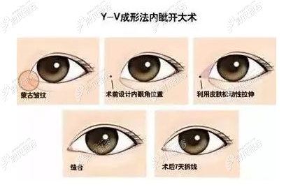 内眼角手术流程