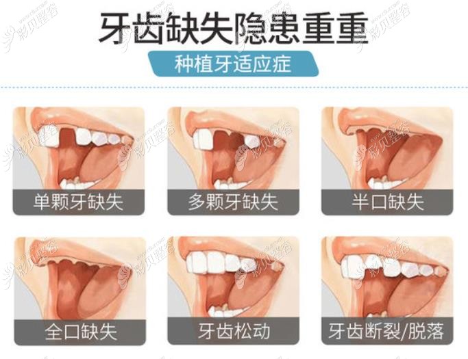 德国费亚丹种植牙适合哪种人群