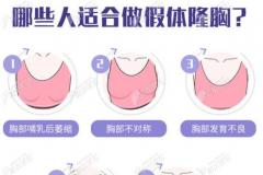 重庆隆胸排名前十的医生来自这几家做假体丰胸好口碑医院