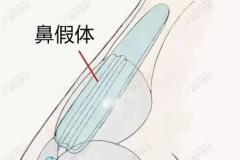 杭州肋骨鼻做的好的医生做肋软骨加假体的价格得多少钱