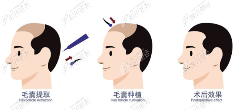植发过程图解