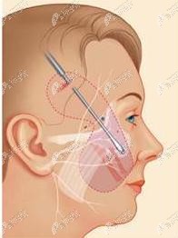 V美减龄提升切口示意图