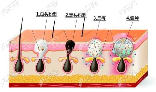脸上的凹陷疤痕怎么去除？果酸焕肤是修复方法之一
