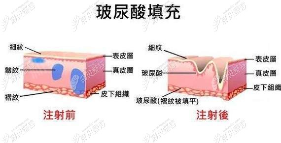 玻尿酸填充作用原理