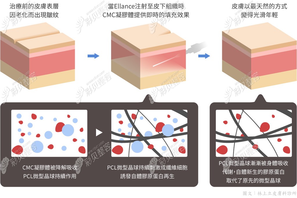 ellance少女针作用原理