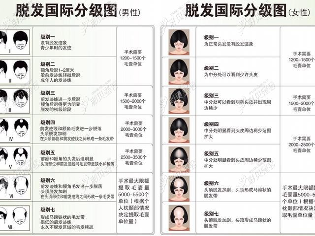 大麦微针植发毛囊数量影响植发价格 大麦微针植发毛囊数量影响植发价格