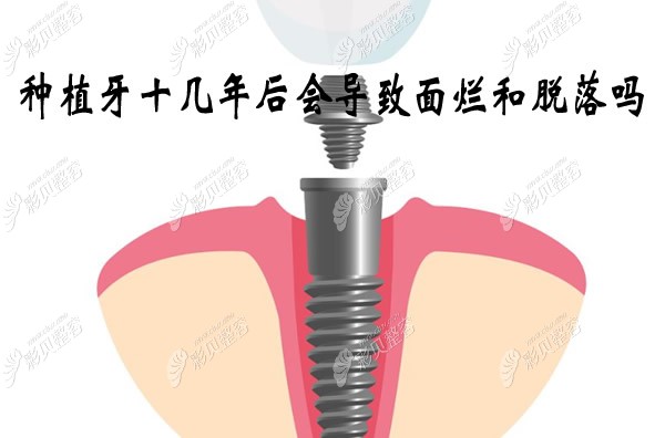 种植牙十几年后会导致面烂和脱落吗