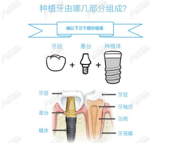 种植牙由植体基台和牙冠三部分组成