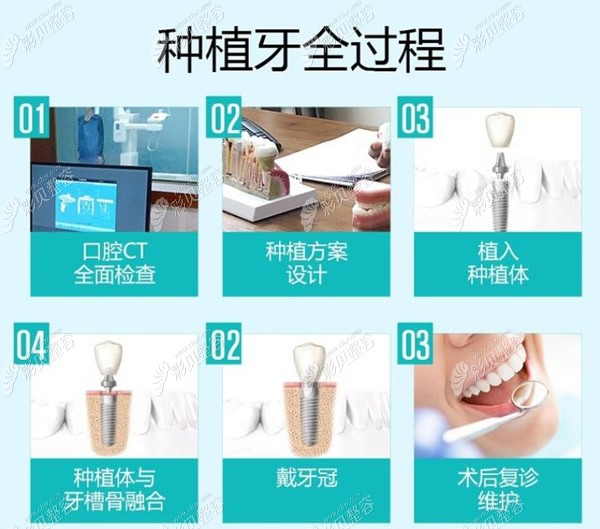 种植牙全过程和步骤
