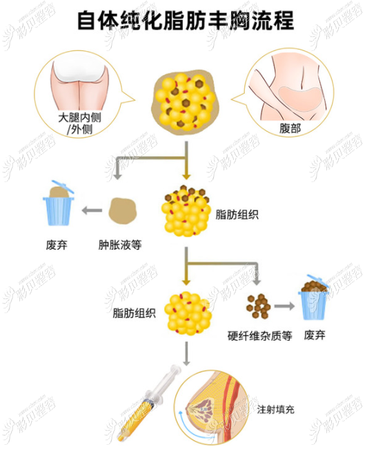 自体脂肪丰胸的过程