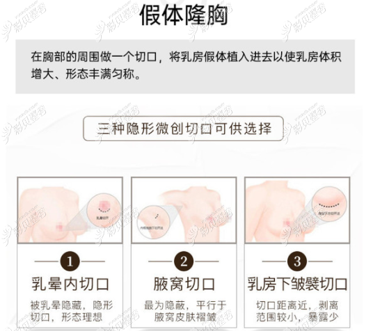 假体隆胸的三种切口