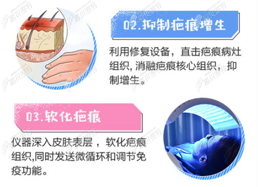 深圳鹏程医院激光祛疤的过程