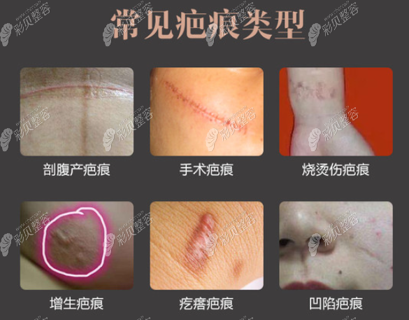 深圳鹏程修复疤痕增生怎么样