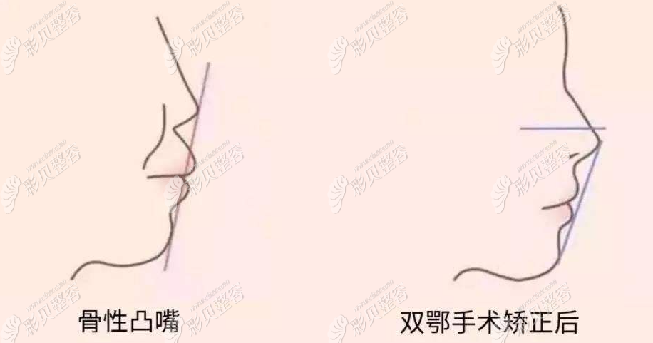 骨性凸嘴可以通过正颌/双鄂手术来纠正