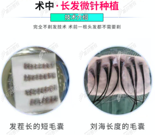 不剃发植发分长发和短发种植