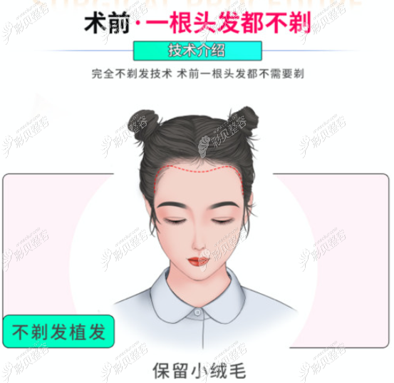 不剃发植发是什么意思