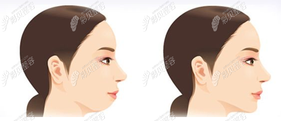 做完双鄂手术前后对比图