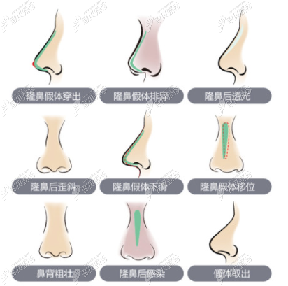鼻整形不满意为什么不能立即修复,原医院修复还要钱吗