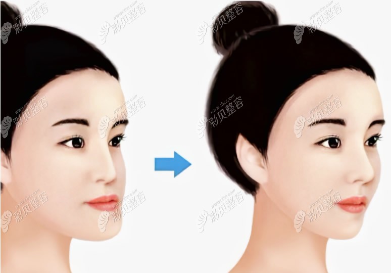 骨性偏颌做正颌手术前后对比照片