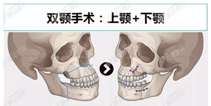 正颌手术过程图解