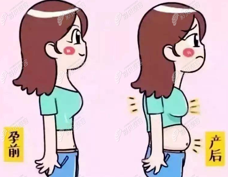 腰腹吸脂后要二胎会复胖吗