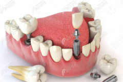 诺贝尔种植牙系统有哪些档次，是终身质保吗