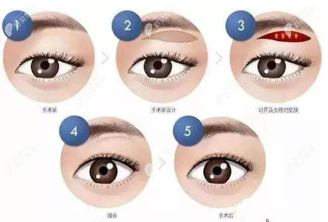 提眉（悬眉）手术过程