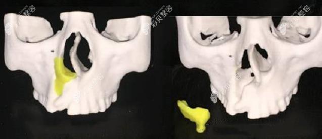 唇腭裂可以使用3D打印技术修复啦，术前后变化能直接看到
