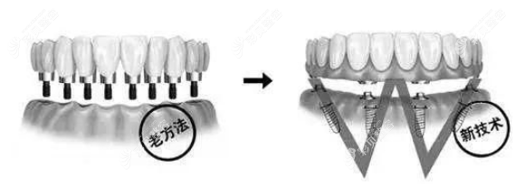 种植牙技术对比