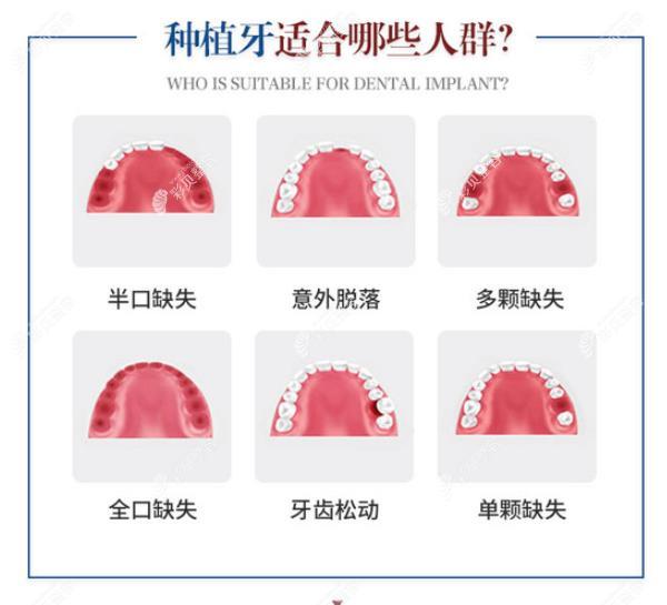 种一颗瑞士iti种植牙价格是一万七八还是21000? 种一颗瑞士iti种植牙价格是一万七八还是21000?