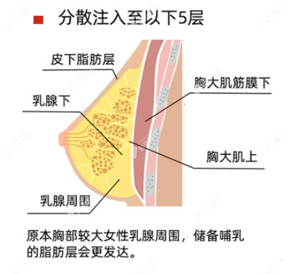 昆山玥美傅立志医生丰胸优势