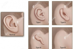 从做耳再造手术的条件看并不是所有小耳畸形都能做耳再造
