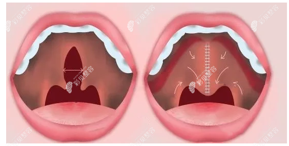 唇腭裂是怎么修复的 唇腭裂是怎么修复的