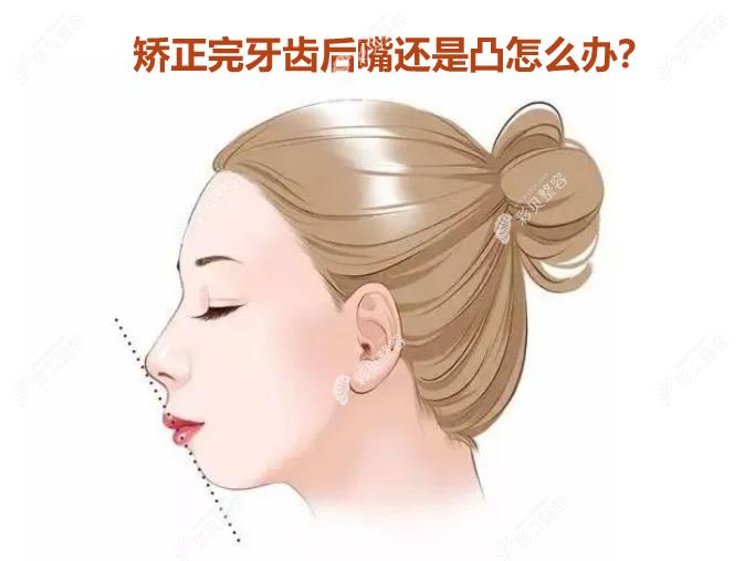 矫正完牙齿还是嘴凸怎么办