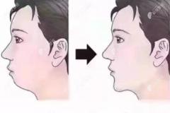 嘴凸下巴后缩怎么矫正?改善方法是整牙还是做下巴截骨前移