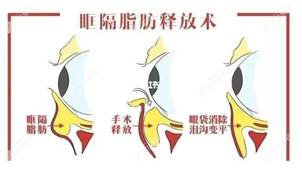 北京魏志香医生眶隔释放去眼袋+填充泪沟的价格和过程攻略
