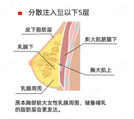 绵阳朗睿整形杨俊做自体脂肪丰胸的优势
