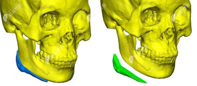3D打印下颌角