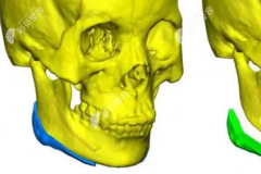medpor曼特波修复下颌角和peek人工骨材料修补下颌角哪个好