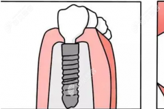 种植牙的骨粉对人体有害吗,牙齿种植骨粉后有什么副作用呢