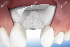 种植牙的骨粉对人体有害吗,牙齿种植骨粉后有什么副作用呢