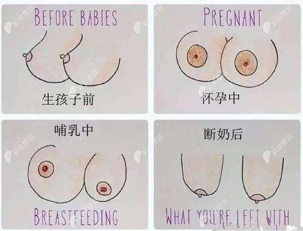 哺乳期妈妈胸型变化过程图