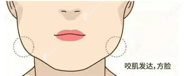 下颌角肥大、咬肌大是什么样 下颌角肥大、咬肌大是什么样