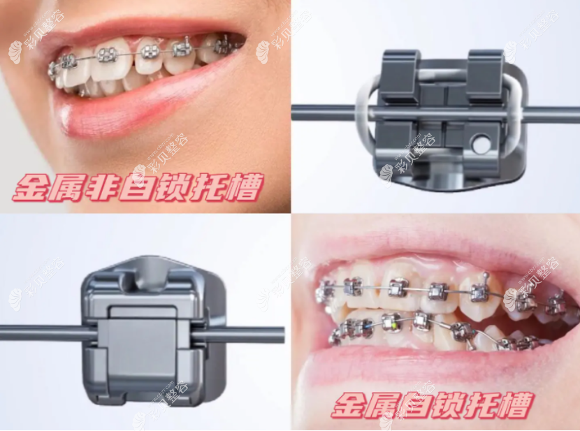 金属自锁牙齿矫正手术
