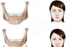 脸部下颌角整形手术后注意事项有哪些？
