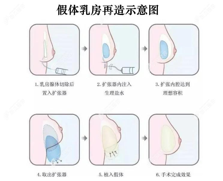 假体乳房重建再造示意图
