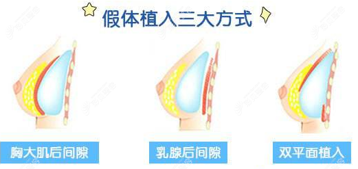 假体隆胸植入方式